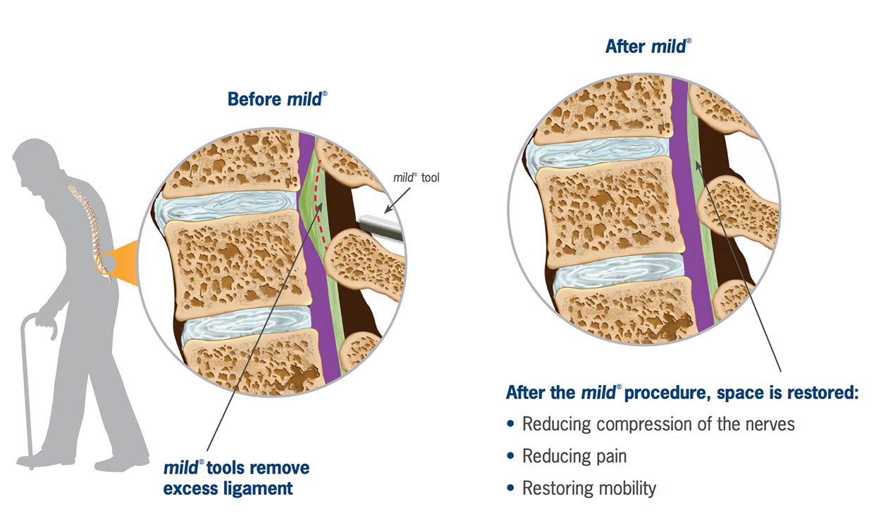 mild procedure before after